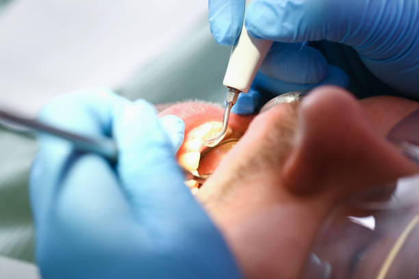 Best Dentist for Tooth Abscess  in Commercial Point, OH