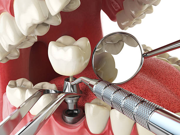 Best Chipped Tooth Repair Near Me  in Commercial Point, OH